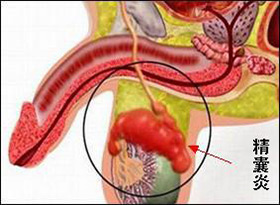 精囊炎怎么治疗才能彻底治愈